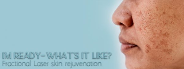 I’m Ready – what is it like? Fractional laser skin rejuvenation treatments