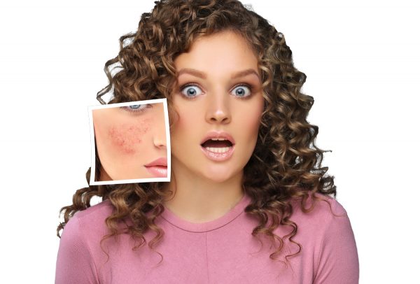 Laser Treatment for Rosacea and Redness