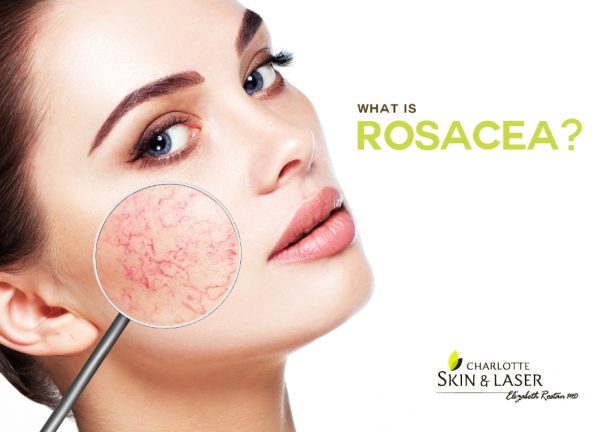 What is rosacea?