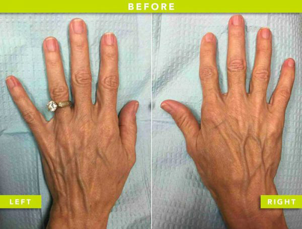 before Sclerotherapy and Radiesse® filler to reverse hand aging