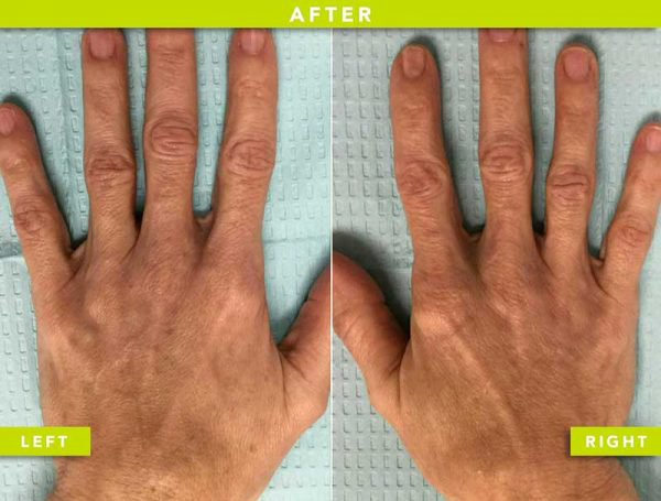 after Sclerotherapy and Radiesse® filler to reverse hand aging