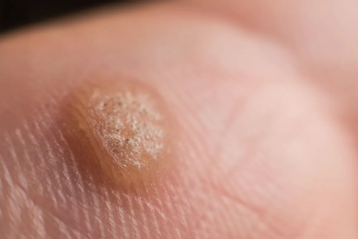 Warts: Why You Should Not Ignore