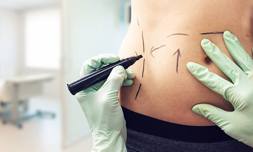 Understanding Lipo-Sculpture: Distinguishing It from Liposuction