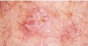 Actinic Keratosis