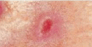 Basal Cell Carcinoma