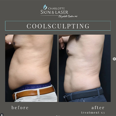 Before and after coolsculpting male patient left side Charlotte Skin & Laser