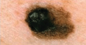 Melanoma