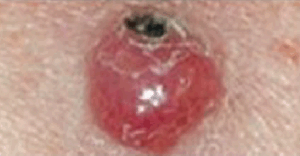 Merkel Cell Carcinoma