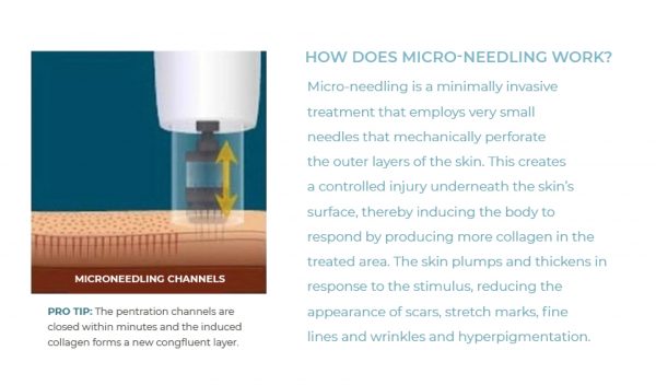 Micro Needling 101 (InfoGraphic)