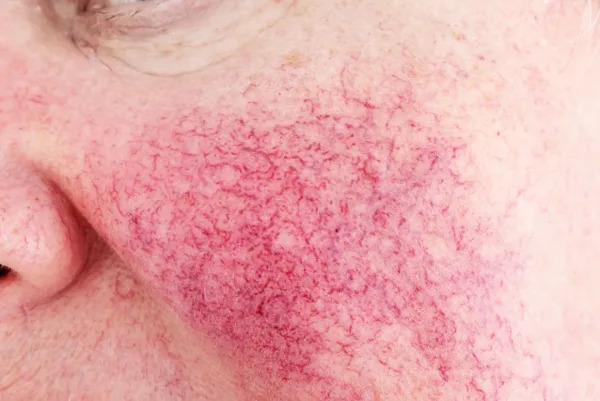 Rosacea Awareness: Caring For Your Rosy Skin
