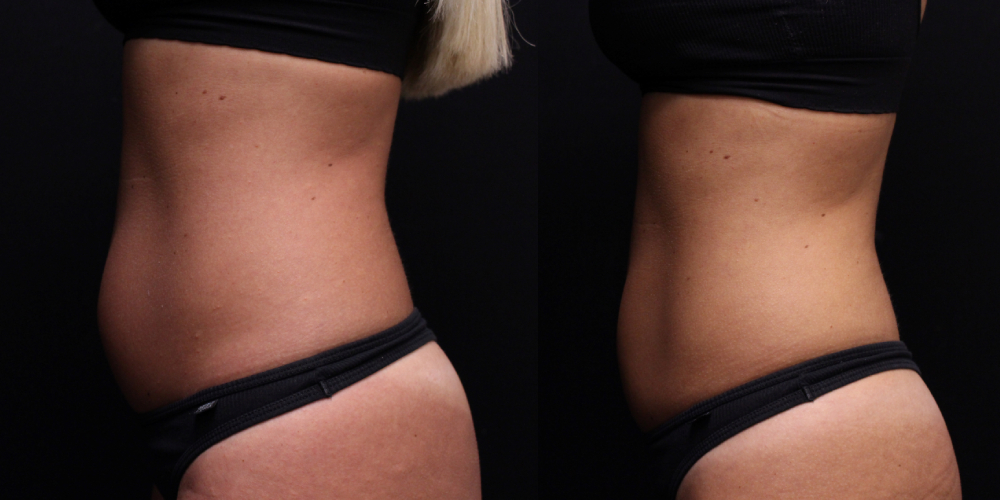 before and after body contouring female patient left sideview case 900