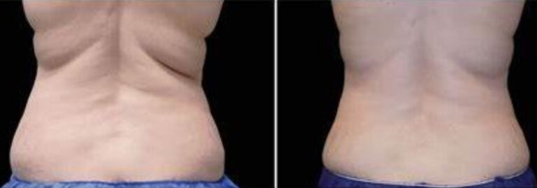 before and after neck contouring back view case 904