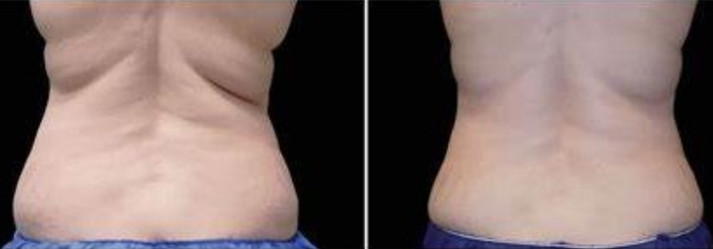 before and after neck contouring back view case 904