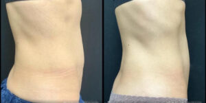 before and after neck contouring right side view case 905