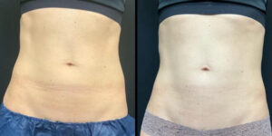 before and after neck contouring front view case 905