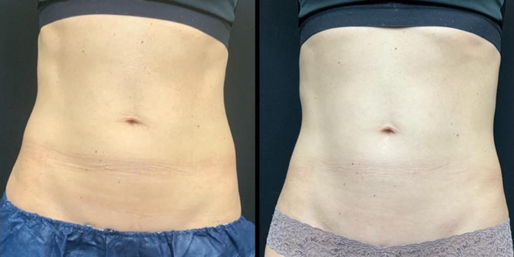 before and after neck contouring front view case 905