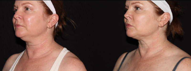 before and after neck contouring female patient left angle view case 910