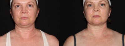before and after neck contouring female patient front view case 910