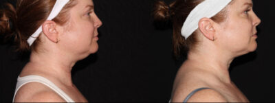 before and after neck contouring female patient right side view case 913