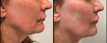 before and after dermal fillers female patient right side