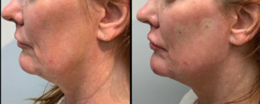 before and after dermal fillers female patient left side