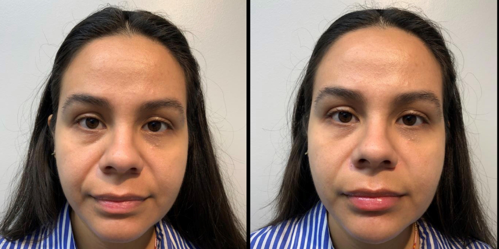before and after dermal fillers around mouth folds female patient front