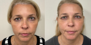 before and after dermal fillers around the mouth female patient front view