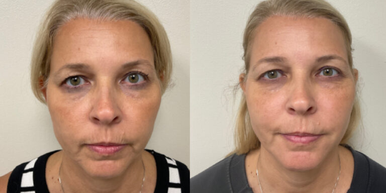 before and after dermal fillers around the mouth female patient front view