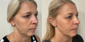 before and after dermal fillers female patient left angle
