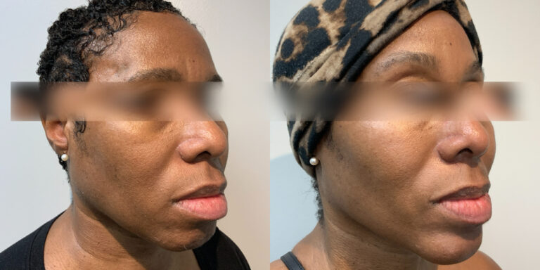 before and after dermal fillers in the cheek female patient left angle view