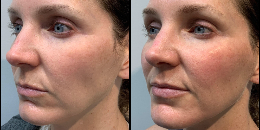 before and after dermal fillers female patient right angle view
