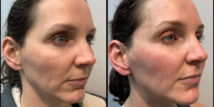 before and after dermal fillers female patient left angle view