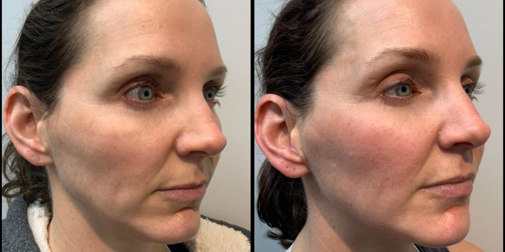 before and after dermal fillers female patient left angle view