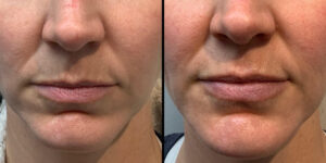 before and after dermal fillers on the lips Charlotte Skin & Laser