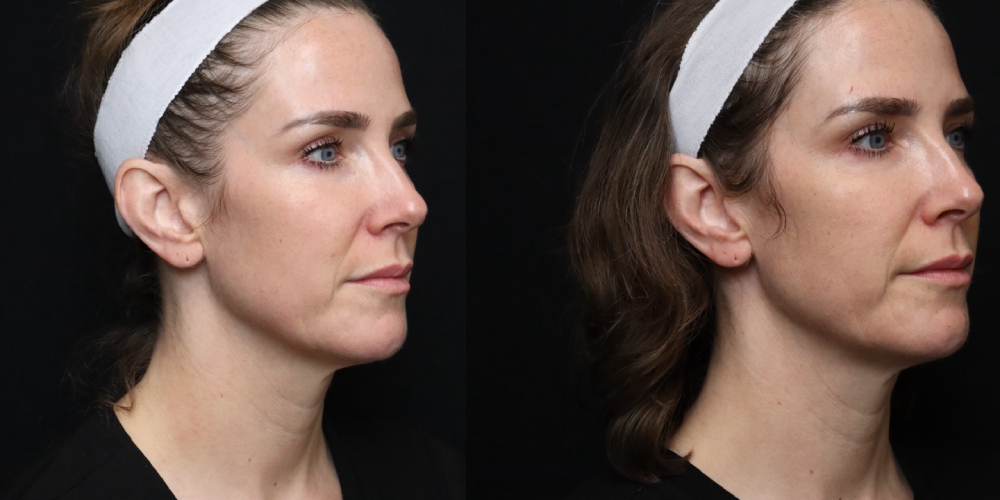 Before and after Infini Genius angle view Case 890