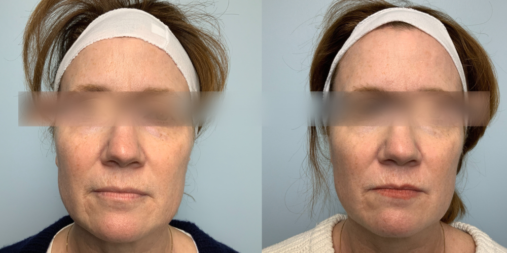 Before and after Infini Genius front view Case 895