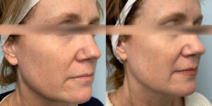 Before and after Infini Genius angle view Case 895