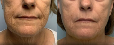 Before and after Infini Genius front view Case 895