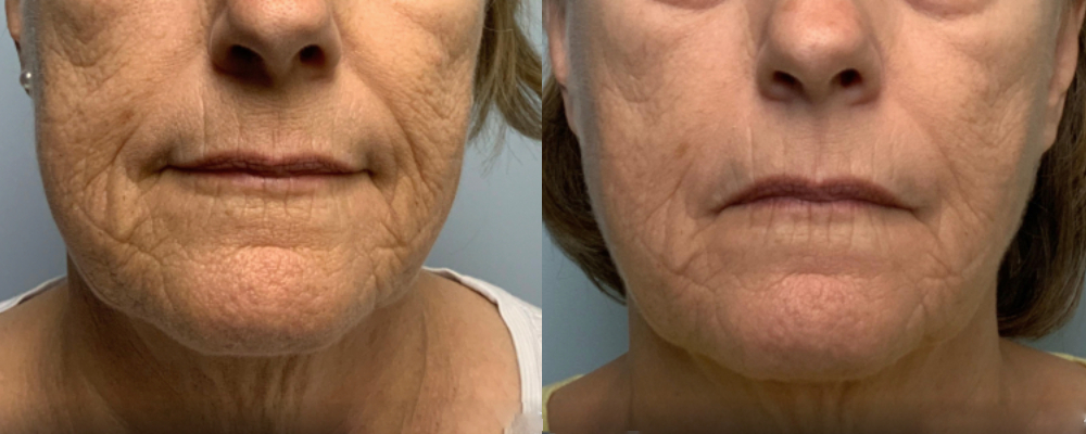 Before and after Infini Genius front view Case 895