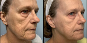 Before and after Infini Genius female left cheek Case 895