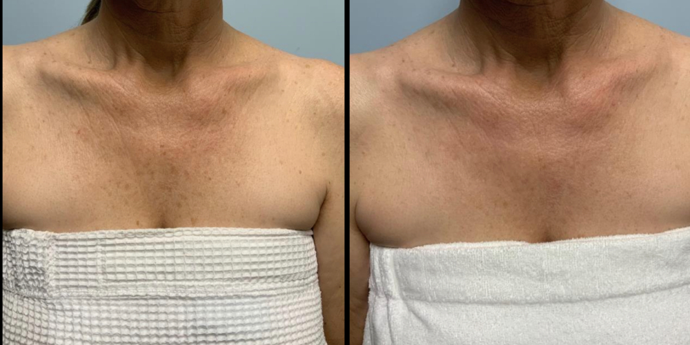 Before and after IPL front view Case 882