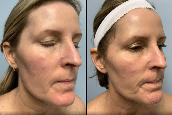 Before and after IPL angle view Case 882