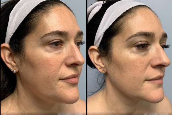 Before and after Ipl front view Case 885