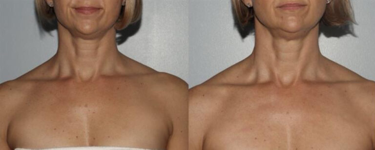 Before and after IPL front view Case 887