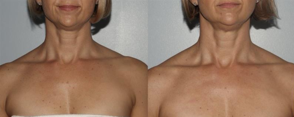 Before and after IPL front view Case 887