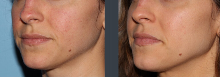 before and after non-abrasive laser resurfacing left angle mouth view case 852