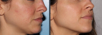 before and after non-abrasive laser resurfacing left angle mouth view case 852