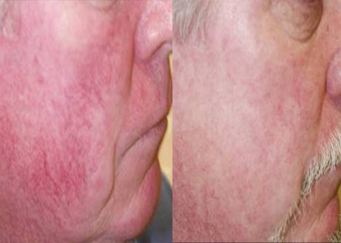 before and after non-abrasive laser resurfacing right side view male patient case 855