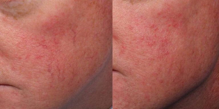 before and after non-abrasive laser resurfacing left view male patient case 862