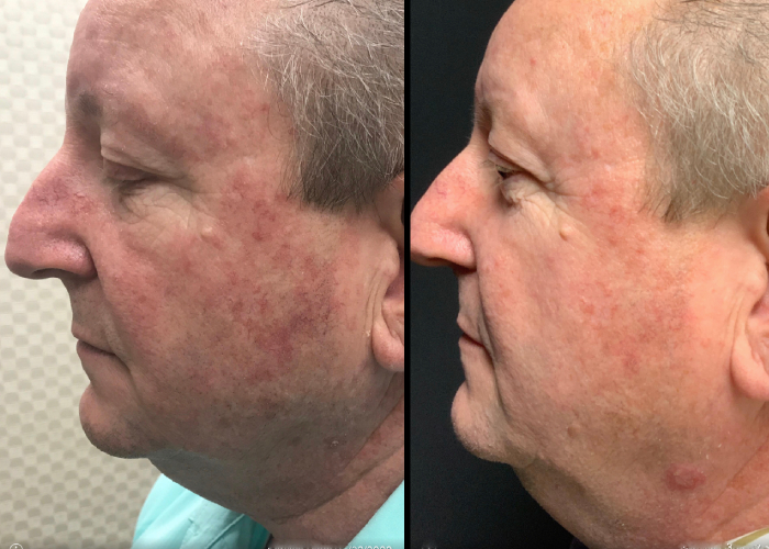 before and after non-abrasive laser resurfacing left side view case 860